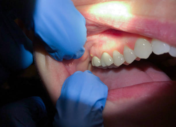 Best Emergency Dental Care for Broken or Chipped Teeth in Methuen Town, MA