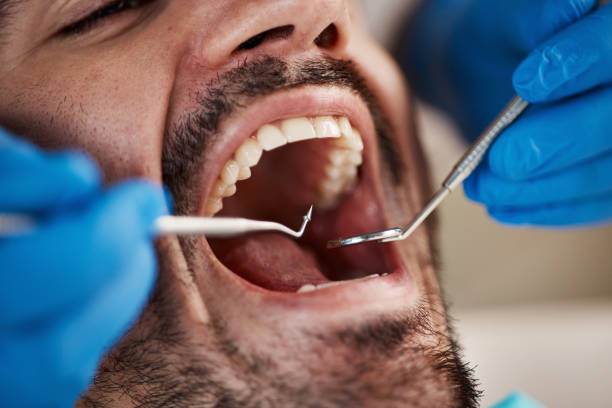 Best Emergency Wisdom Teeth Removal in Methuen Town, MA